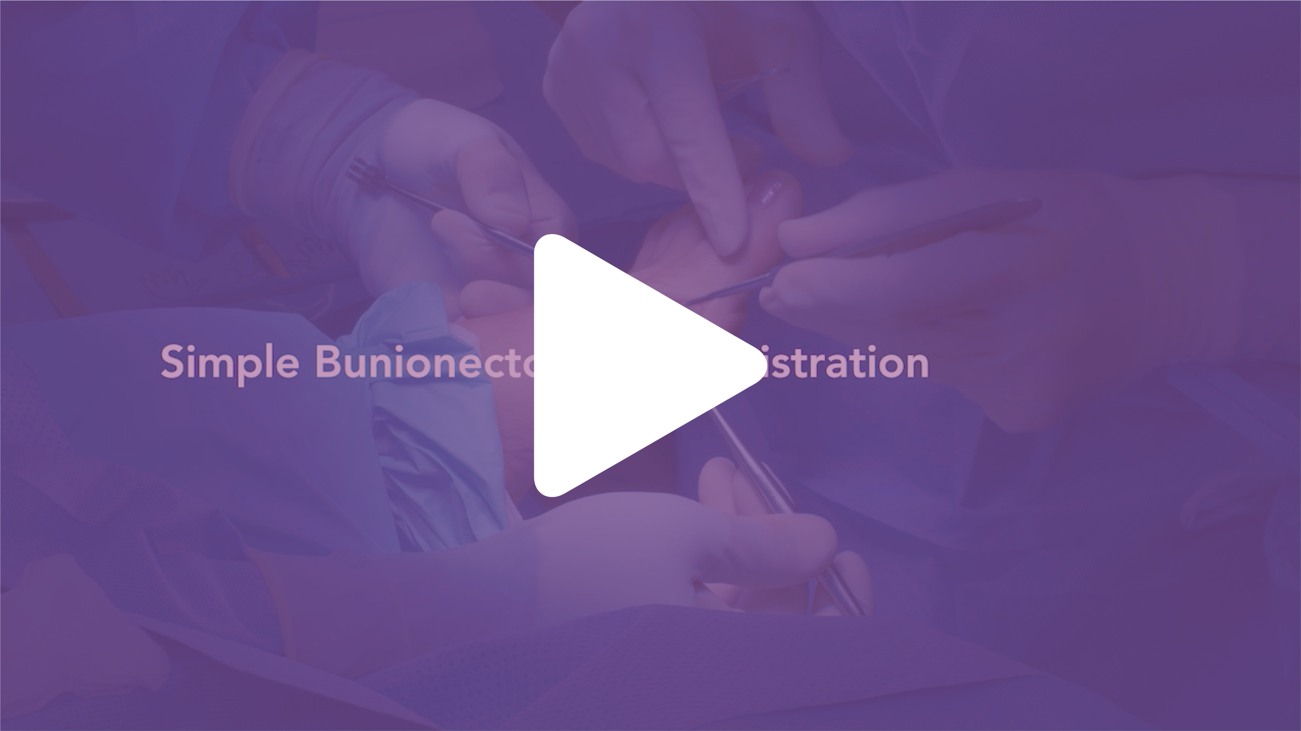 Play video for Bunionectomy